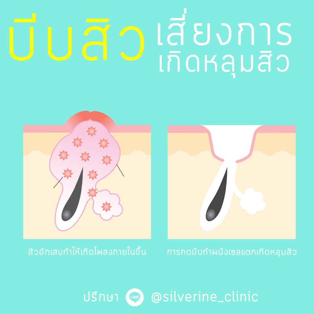 4 เหตุผลทำไมไม่ควรบีบสิวเอง